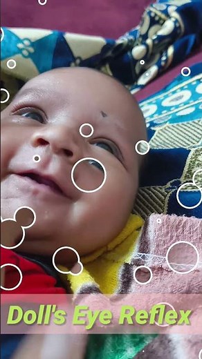 Doll's eye Reflex