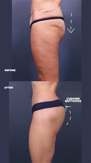 This Bikini Body Lift Transformation is Insane #beforeandafter #bodysculpting