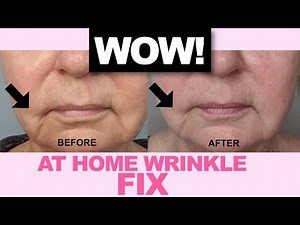 Home Wrinkle Treatment - Before & After Pics - NIRA Laser Over 50
