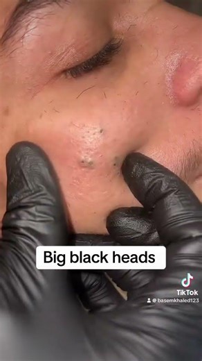 Big black heads