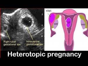 Heterotopic Pregnancy Diagnosis on Ultrasound Made EASY!