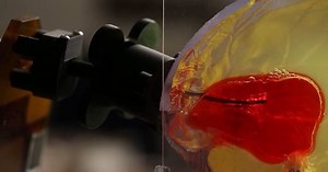 Blood clots could be sucked out of the brain by a robotic device