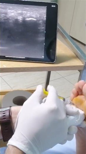 morton s neuroma injection