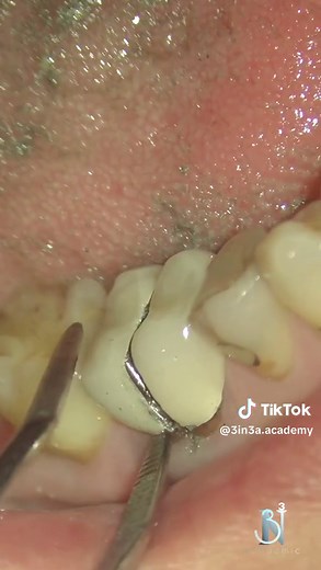 To Remove an Old Crown (porcelain Fused to metal Crown) - To Remove an old crown, it's Better to split it in Half Rather Than pulling off - This is a porcelain fused to metal Gown So I started with A diamond Bur to cut through The facing ceramic Then switch to a carbide Bur to cut through the Metal Core - once a split is made an instrument is care fully to Separate and Remove the cut pieces. -Now we Have the Crown Safely removed. #education #popular #dentist #3in3a