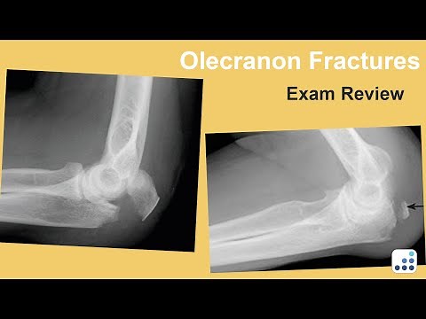 Olecranon Fractures - Joaquin Sanchez-Sotelo, MD