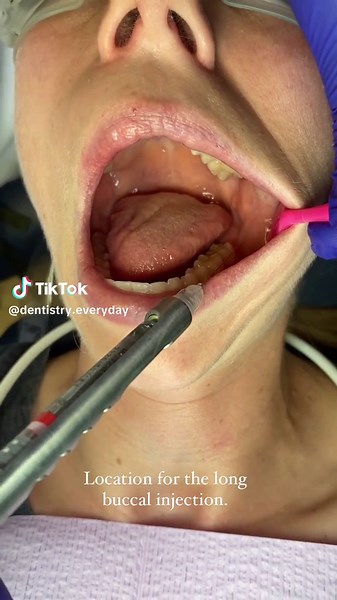 Effective Techniques for Long Buccal Injection in Dentistry