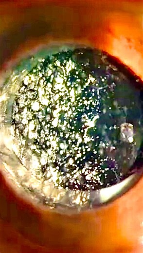 Asteroid hyalosis is a benign vitreous condition characterized by numerous tiny, white-yellow calcium-lipid deposits suspended within the vitreous gel. These particles can look dramatic on fundus exam, often sparkling and highly reflective, yet they typically cause little to no visual symptoms. It’s most commonly unilateral and seen in older patients, with associations including diabetes and systemic metabolic conditions—though a direct cause isn’t always found. Despite its striking appearance,