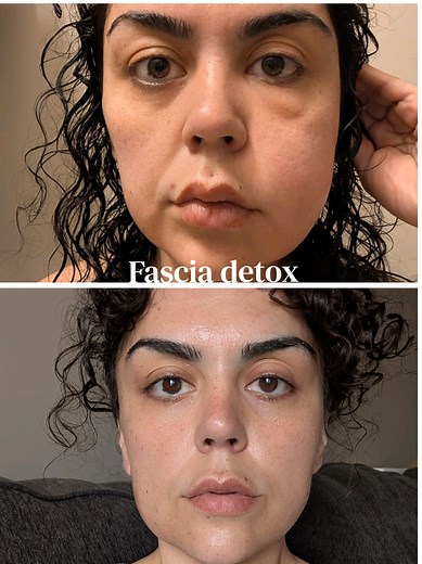 Don’t release your fascia if you’re not ready for THIS… When you start breaking up fascia adhesions, your body can go into a temporary detox phase. That means fatigue, soreness, emotional release, and your lymphatic system working overtime. This isn’t a bad thing-it’s your body finally processing what’s been stuck. But you need to go slow, stay hydrated, and support your body through it. Fascia isn’t just physical… it holds stress, trauma, and inflammation too. When it releases, everything moves