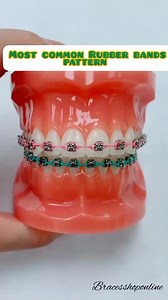 If you’re curious about how rubber bands work on braces, you’re probably already familiar with them. Orthodontic rubber bands, also called elastics, are small but powerful latex rings that go on top of the hooks of your braces. Their purpose is to move teeth or groups of teeth and settle your bite. #bracestipsandadvice #dentalideas #braceslife #bracescare #BracesTips #everyone #followers #highlights #braces | Braces Shop Online