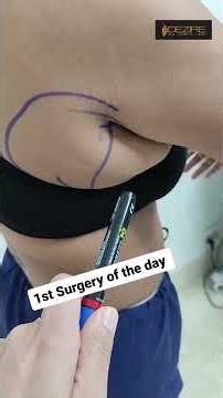 Axillary Fat Removal