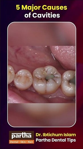 5 Major Causes of Cavities