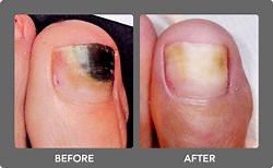 PinPointe Laser Nail Treatmente Laser Treatment | Kentlands Foot & Ankle Center