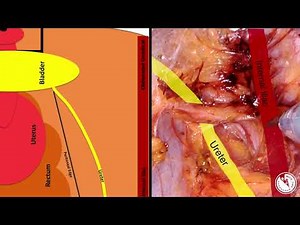 Anatomy Review: Pelvic Sidewall Avascular Spaces • Video • MEDtube.net