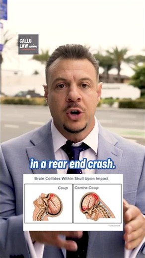 The Brain Injury Your CT Scan Completely Missed | Gallo Law