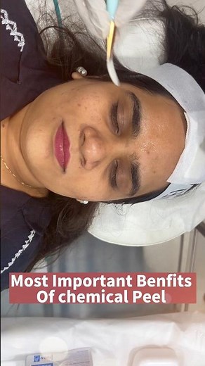 What Are The Benefits of Chemical Peel Treatment? #peel #chemicalpeel #skincare #skinglow