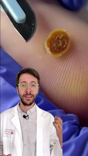 Dermatologist explains: How to correctly remove warts | DERMAFY #shorts