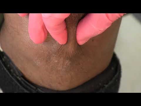 Performing Routine Skin Smears