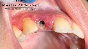 Difficult brittle remaining root extraction by straight elevator