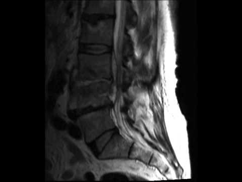 Discitis Osteomyelitis
