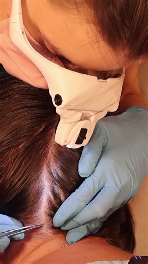 ASMR Doctor LICE Check on Scalp and Neck | Lice Removal with a Comb and Tweezers #asmr #short