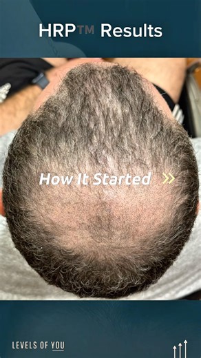 21-month hair loss transformation w HRP™️ #HRP™️ #hairtransformation #hairlosstreatment #DrHopkirk