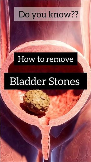 Suffering from Bladder stones??#bladderstones #3danimation