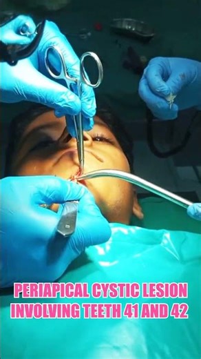 🦷 Periapical cyst with draining sinus managed at Shakun Dental | Expert Oral Surgery Care