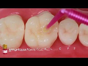 GC Equia Forte HT Class I Restoration