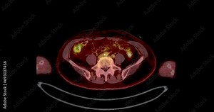 A PET-CT scan is a diagnostic imaging technique combining positron emission tomography (PET) and computed tomography (CT) in cancer diagnosis and staging.