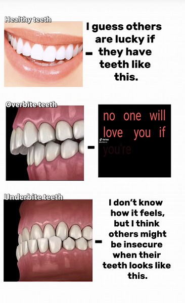 Understanding Overbite: Causes & Correction