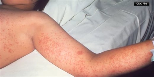 Potential measles exposure at Eisenhower Airport, Hutchinson Library and auto shop in SW Kansas