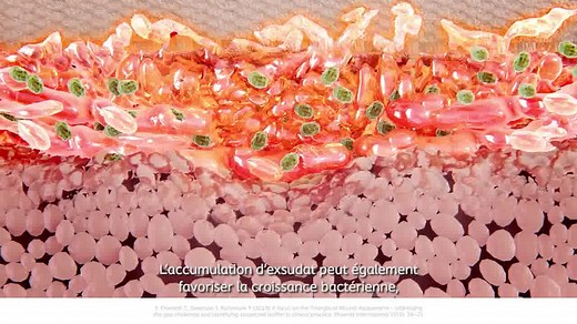 Evaluer et prendre en charge l’exsudat dans le soin des plaies : pourquoi est-ce important ? L'exsudat est un élément naturel et essentiel du processus de cicatrisation de la plaie. S'il n'est pas évalué et géré correctement, il peut causer des problèmes*. Par exemple, si l'exsudat commence à s'accumuler dans le lit de la plaie, il peut provoquer des fuites et la macération de la peau péri-lésionnelle, ce qui peut entraîner un retard de cicatrisation. ** * World Union of Wound Healing Societies