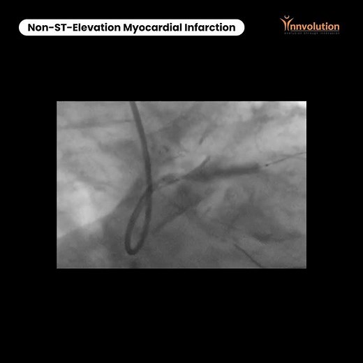 Non ST Elevation Myocardial Infarction