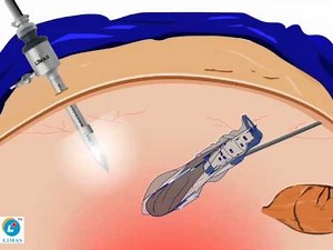 Power morcellation with LIMAS Safety Isolation Bag - A tutorial video