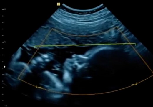 Ultrasound, Pregnancy, Hospital. Free Stock Video