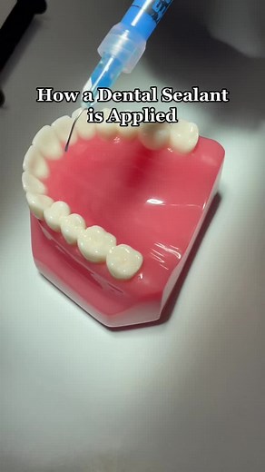 How Tooth Sealants Are Applied: A Guide for Parents