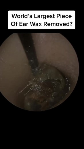 #ear #earwax #earwaxremoval #microsuction #audiology