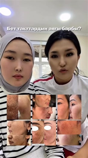 Косметолог \ Пластический хирург \ Бишкек on Instagram: "Сепкилдерден арылгыңыз келеби? Реалдуу жыйынтык!😍 Сиздин да бетиңизде сепкил болсо келиниз. Москва 13-14-15-16-17 Февраль 🔻Баасы кимге кызык? Комментарийге + калтырыңыз ✅ ✅ Лицензияланган клиника! 📲0707600726 📲0556877782 📍Московский 191/Уметалиева #косметология #чисткалица #акне #мээримдавлетова #Кыргызстан"