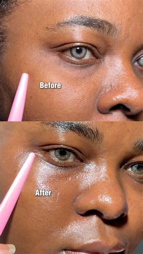 How to clear saggy under eye @d@dr.althea_official #eyeroller #eyeserum #retinol #bloomers