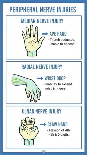 Struggling to remember which nerve causes which hand deformity?