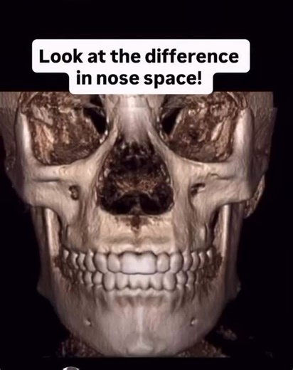 👃 Look at the difference in nasal space This image shows something most people never realize… The upper jaw isn’t just about teeth — it forms the floor of the nose. When the upper jaw is narrow, the nasal cavity is narrow too. That means less room for air to flow. When we help guide proper jaw development or expansion, we’re not just creating a nicer smile — we’re helping create more space to breathe. More nasal space can support: ✨ Easier nasal breathing ✨ Better oxygen flow ✨ Improved sleep q