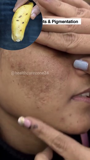Clean Dark Spots & Get Glowing Skin With Banana ~ Try This Once & See the Difference! | Health Care Zone