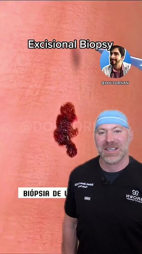 Understanding Excisional Biopsy: A Detailed Explanation