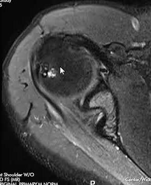 Internal Impingement Shoulder