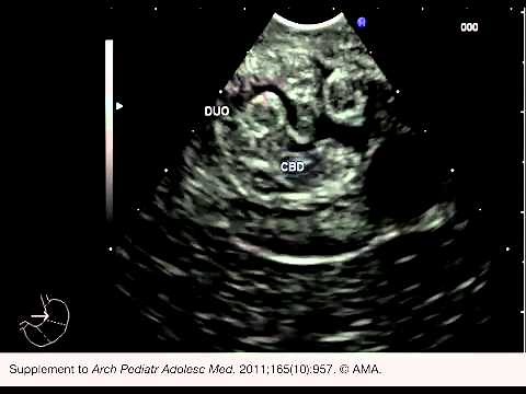 Evaluation of Dilated Common Bile Duct From Duodenum Using Endoscopic Ultrasonography