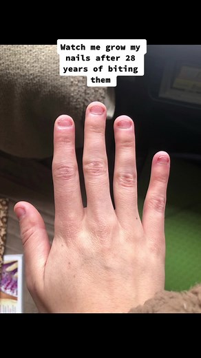 Transformation: Growing Nails After 28 Years of Biting