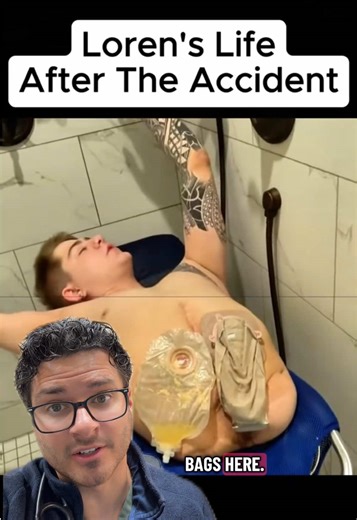 Hemicorporectomy is one of the most extreme operations in modern medicine. It involves surgical removal of the lower half of the body—typically performed only in rare, life-saving situations such as aggressive cancer, severe trauma, or uncontrollable infection. Patients who undergo this procedure face enormous physical and psychological challenges, but survival is possible with meticulous surgical planning, intensive rehabilitation, and long-term multidisciplinary care. It’s a powerful reminder 