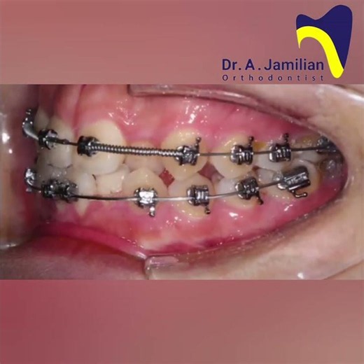 How Fixed Braces Straighten Crooked Teeth | Before & After Braces Treatment #orthodontics #braces