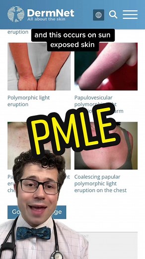 Polymorphic light eruption, also known as sun poisoning, may affect up to 10-20% of people. Here is what you need to know about PMLE #rash #sun #sunscreen #tiktokdoc #allergies #learnontiktok