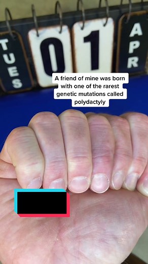 Understanding Polydactyly: Rare Hand Mutations Explained